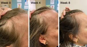 PRP Therapy